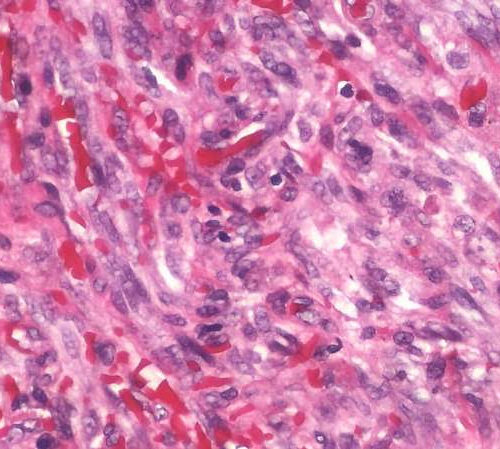 Scientists uncover the ‘Rosetta stone of sarcoma research to personalize treatment