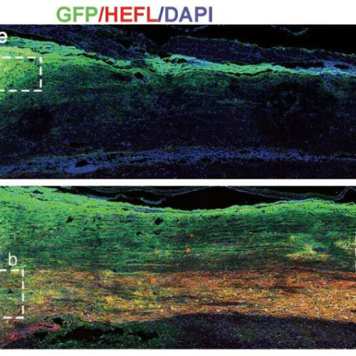Genetically modified neural stem cells show promising therapeutic potential for spinal cord injury