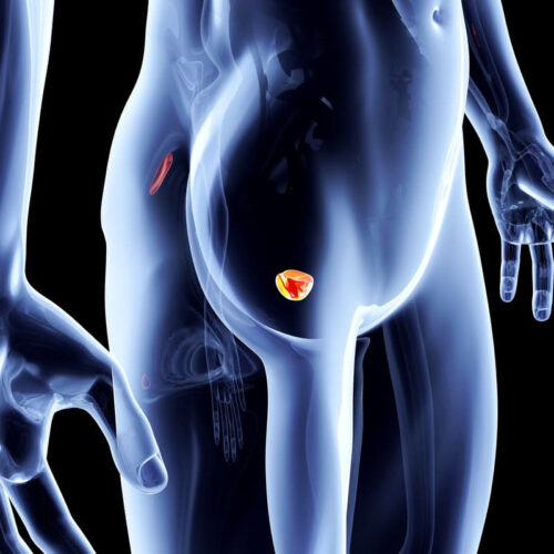 Promising new approach targets aggressive type of prostate cancer