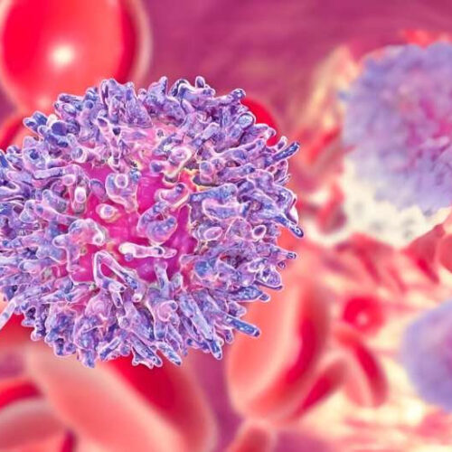 Study finds increased MDS/leukemia risks for survivors of common lymphoid neoplasms
