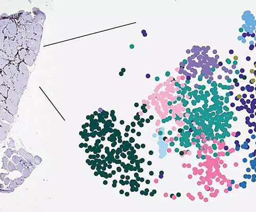 Persistent T cells identified in the muscles of patients with idiopathic inflammatory myopathies