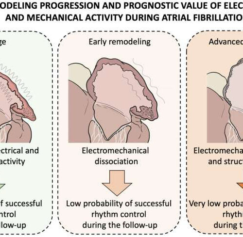 New technique offers improved diagnostic precision, possible personalized therapy for common arrhythmia