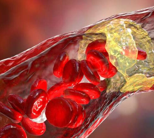 Key molecular pathway affecting atherosclerosis progression discovered