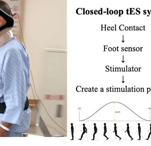 Brain stimulation improves walking in patients with Parkinson’s disease