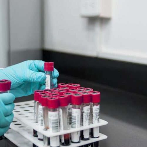 Simple blood test may predict future heart, kidney risk for people with type 2 diabetes