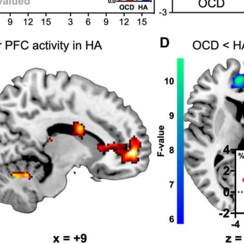 How decision-making mechanisms go awry in OCD brains