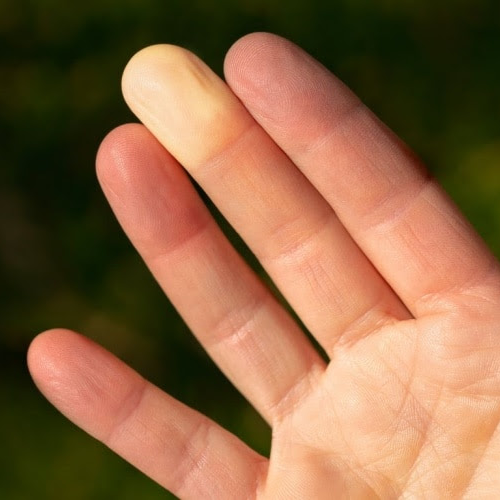 Scientists Spot Genes Linked to Raynaud’s Phenomenon