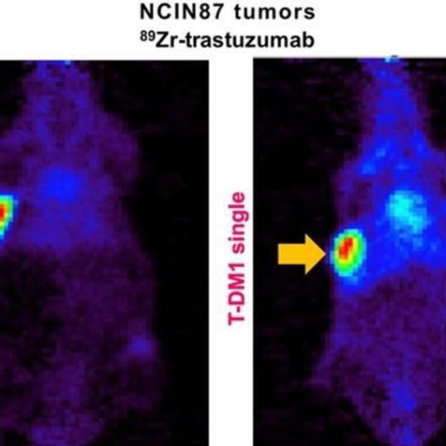 PET imaging validates use of common cholesterol drug to enhance HER2-targeted cancer therapy