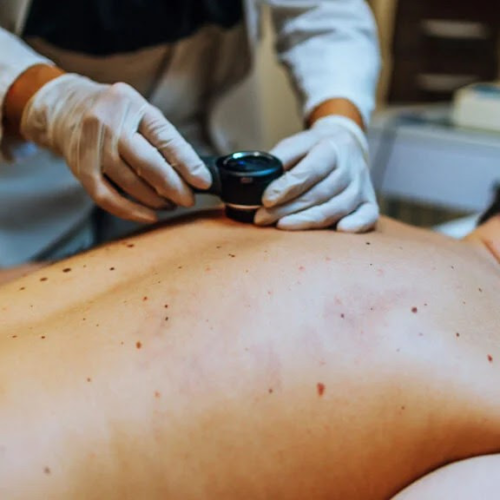 Why non-melanoma skin cancer is now more deadly than melanoma worldwide