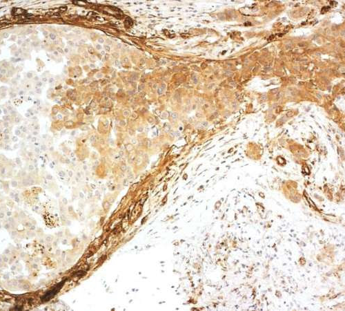 Significant discovery in breast cancer research: Inhibiting collagen XVIII function weakens cancer cells