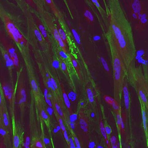 Gene editing system restores dystrophin function in stem cells from patients with Duchenne muscular dystrophy