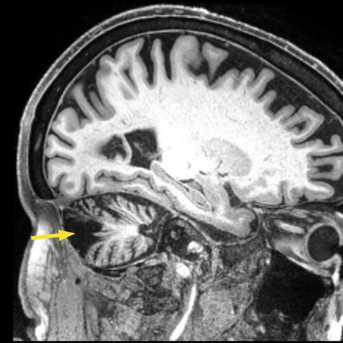 Magnetic stimulation improves movement & balance 12 years after stroke