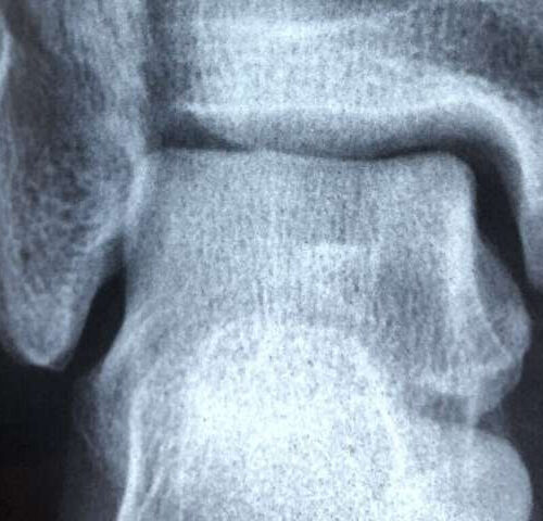 Study finds acute calcium pyrophosphate deposition arthritis doubles fracture risk