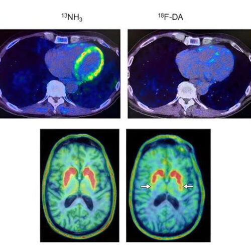 PET scans may predict Parkinson’s disease and Lewy body dementia in at-risk individuals