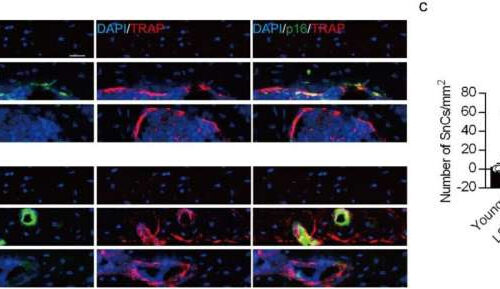 Drug that kills off sleeping bone cells could treat lower back pain