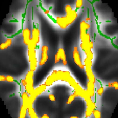 Hidden belly fat in midlife linked to Alzheimer’s disease