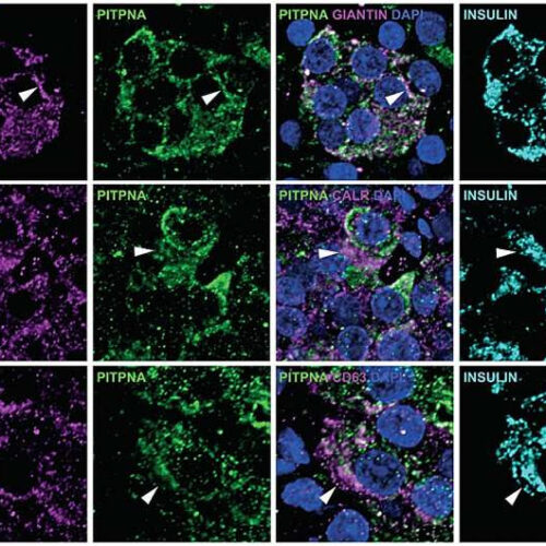 Beta-cells study sheds light on cause of type 2 diabetes