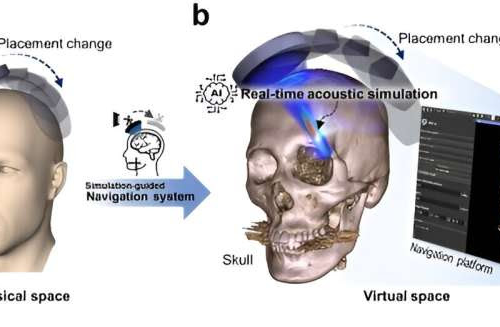 Artificial intelligence lowers the barrier to ultrasound brain disease treatment