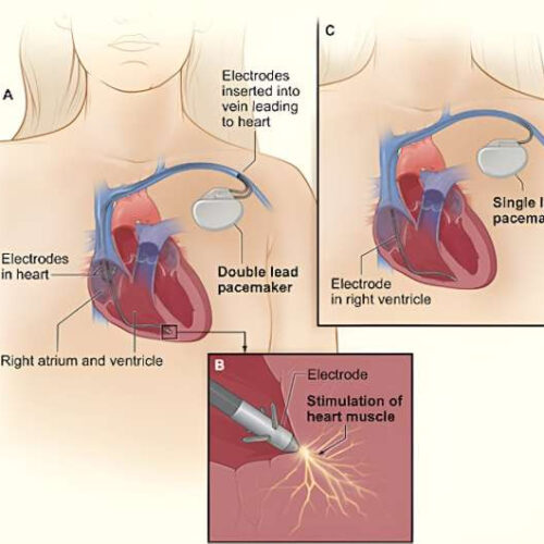 Cardiologist explains how pacemakers and defibrillators interact with the electrical system of the heart