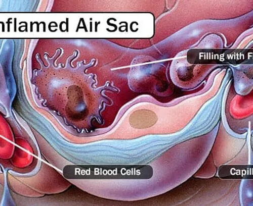 Q&A: ‘White Lung’ Pneumonia – What You Need to Know