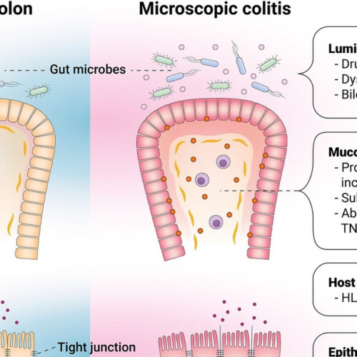 Microscopic Colitis: An Often Misdiagnosed Condition