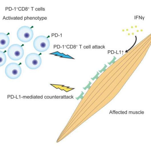 Finding the source of debilitating, body-wide muscular pain and weakness