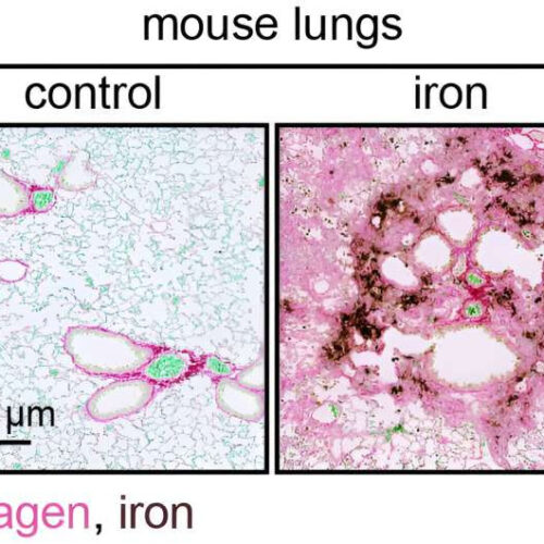 Iron accumulation: A new insight into fibrotic diseases