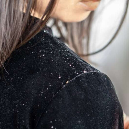 What is dandruff and how is it treated?