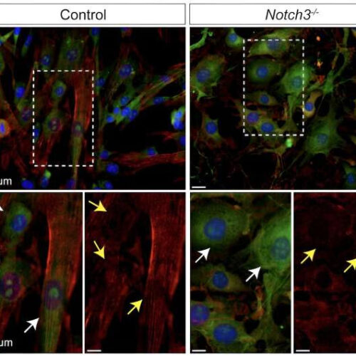 Study discovers novel biomarker for vascular aging and neurodegeneration