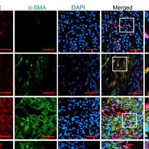 Scientists discover key step to kidney fibrosis