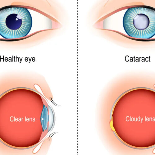 Doctors Reveal the Snack That Cuts Your Risk of Vision-Clouding Cataracts in Half