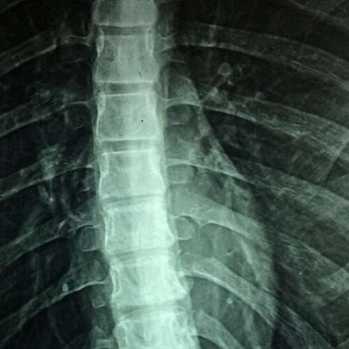 Study shows spinal cord injury causes acute and systemic muscle wasting: Severity depends on location of the injury