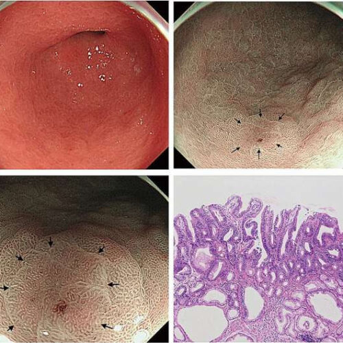 Narrow-band imaging at low magnification can detect lesions overlooked by white-light imaging