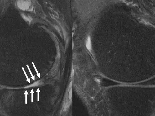 Stronger thigh muscles may prevent knee replacement surgery