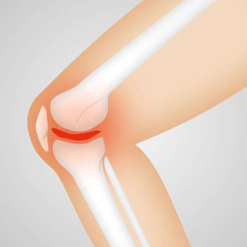 What happens when a kneecap dislocates