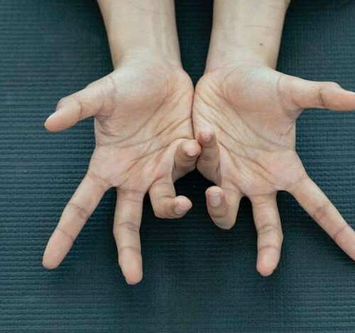 Treating Dupuytren contracture without surgery