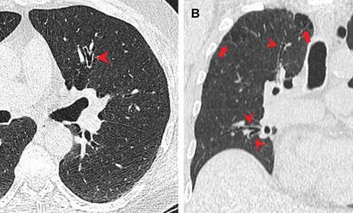 Smoking marijuana in combination with cigarettes increases risk of emphysema, research finds