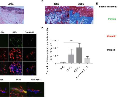 Study uncovers new biological marker for scleroderma