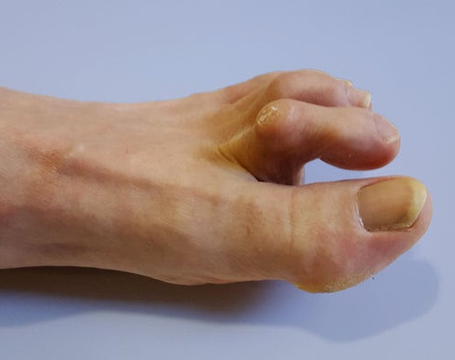 What Is a Hammertoe, and How Can You Fix It?