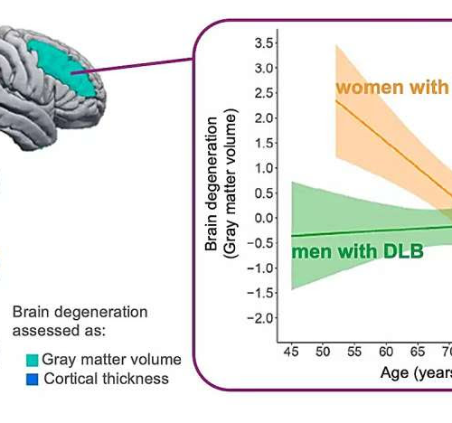 A type of dementia that hits the brains of men and women differently