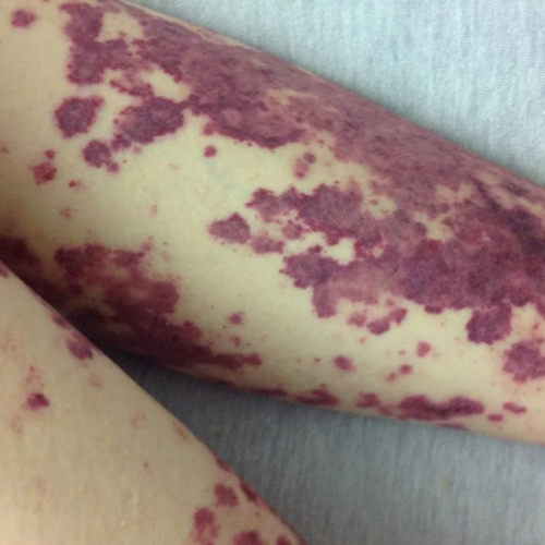 Leukemia rash pictures and symptoms