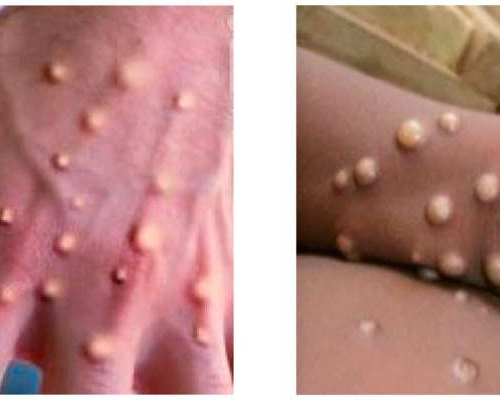 Scientists develop model to distinguish between two strikingly similar diseases blamed for skin lesions