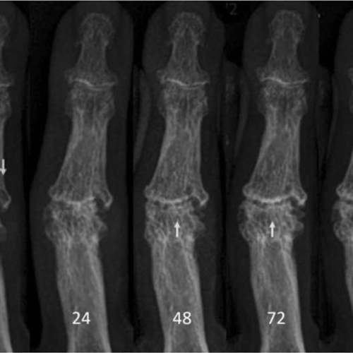 Erosion blockade breakthrough: Clinical trial signals hope for hand osteoarthritis