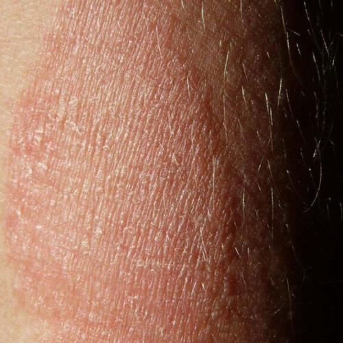 What causes patches of dry skin?