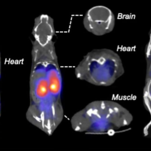 Radioactive ‘fruit sugar’ lights up cancer and inflammation