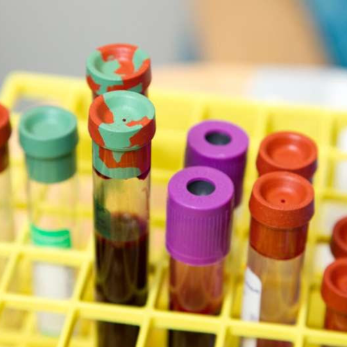 Alzheimer’s blood test found to perform as well as FDA-approved spinal fluid tests