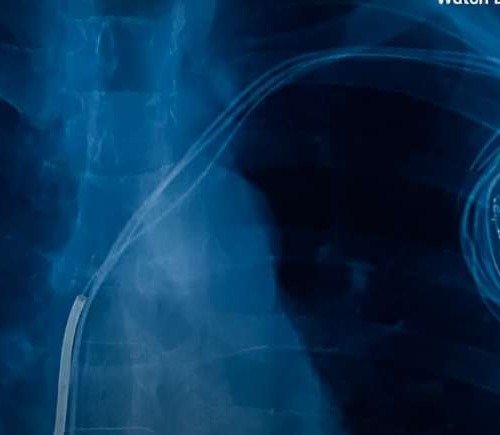 Scientists invent ultra-thin, minimally-invasive pacemaker controlled by light