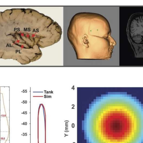 Scientists show focused ultrasound can reach deep into the brain to relieve pain