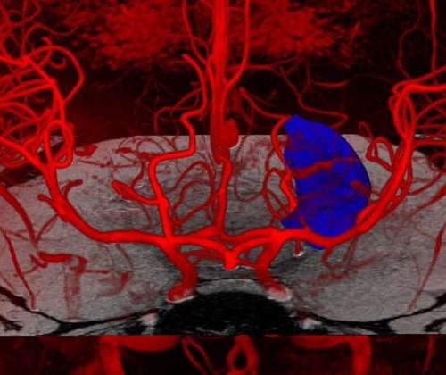 New study expands understanding of brain blood flow and neurological disorders