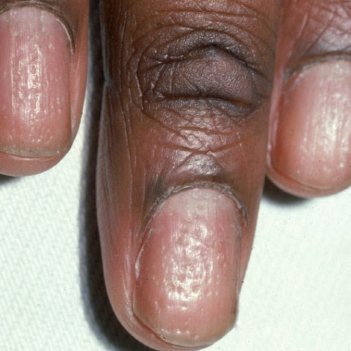 Psoriatic Arthritis Nail Symptoms: 8 Common Signs (With Pictures)